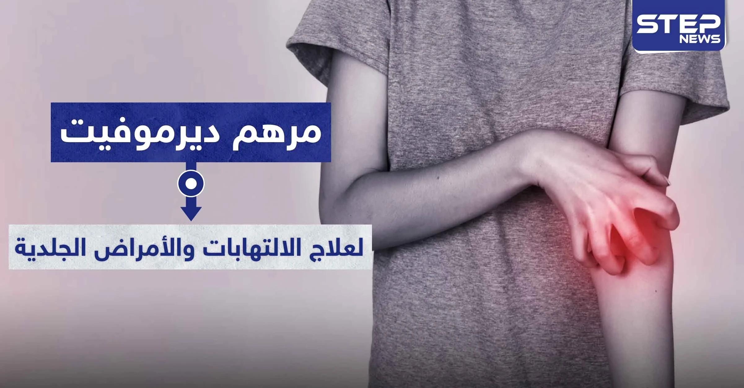مرهم ديرموفيت Dermovate لعلاج الالتهابات والأمراض الجلدية