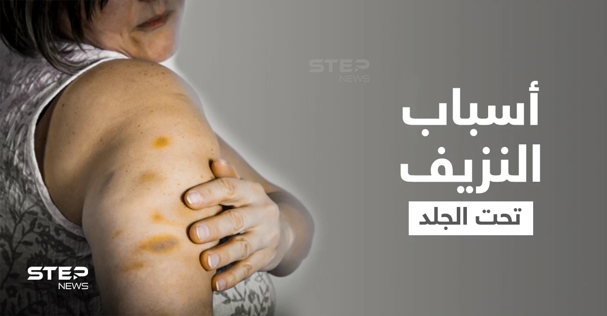 نزيف تحت الجلد... علامات أرجوانية أشبه بالكدمات على الجسم ما هي أسبابها وطرق علاجها
