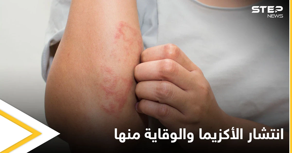 هل تنتشر الأكزيما في الجسم.. وطرق الوقاية منها إليك أهم المعلومات