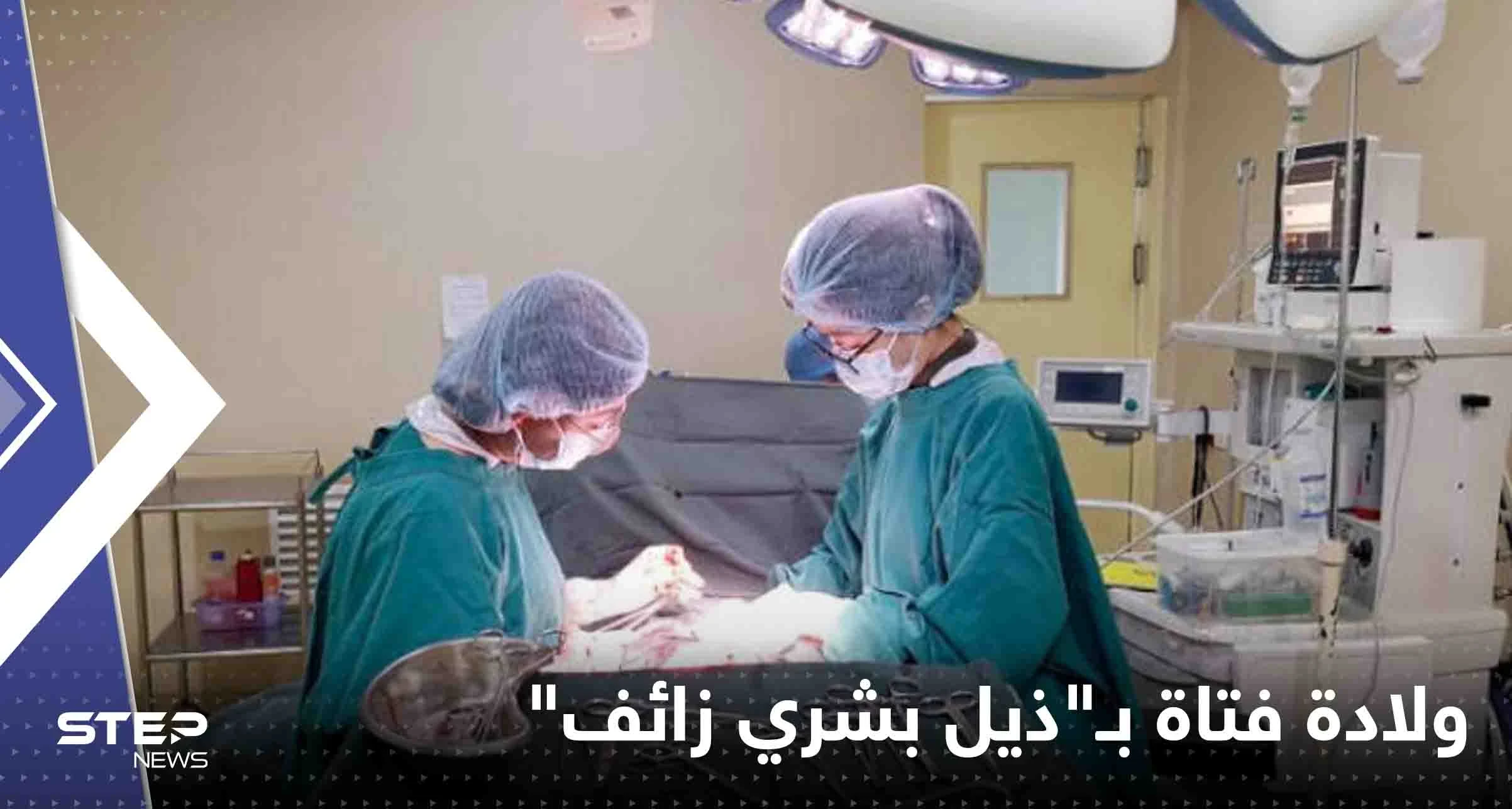 شاهد|| بظاهرة نادرة للغاية.. ولادة فتاة في البرازيل بـ"ذيل بشري زائف"