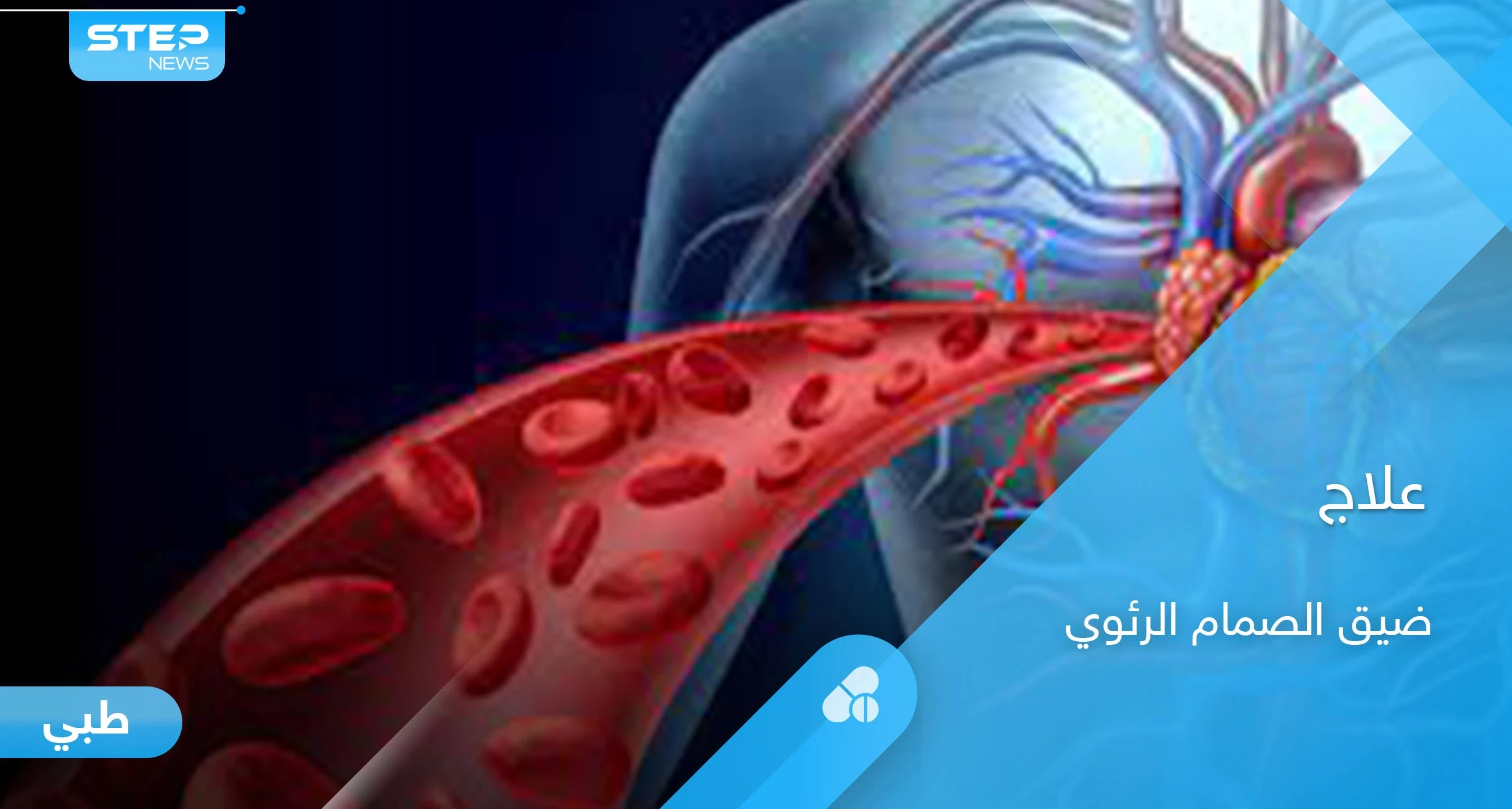 خطورة ضيق الصمام الرئوي وطرق العلاج.. إليك أهم المعلومات