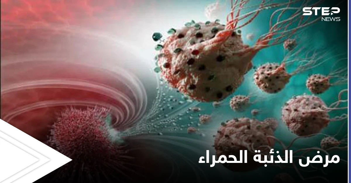 في الشهر العالمي لمكافحته.. تعرف على مرض الذئبة الحمراء وخطورته وأنواعه الشائعة