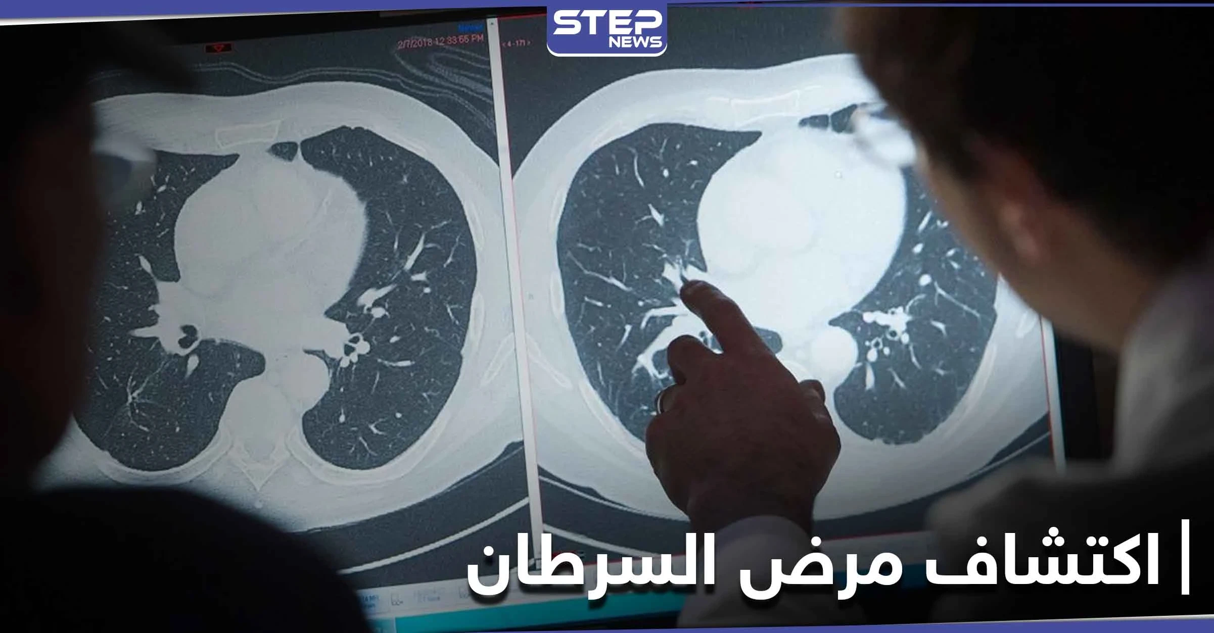علامة تنذر بوجود أورام سرطانية في الجسم قبل ظهورها.. وتمكن من اكتشافها مبكراً
