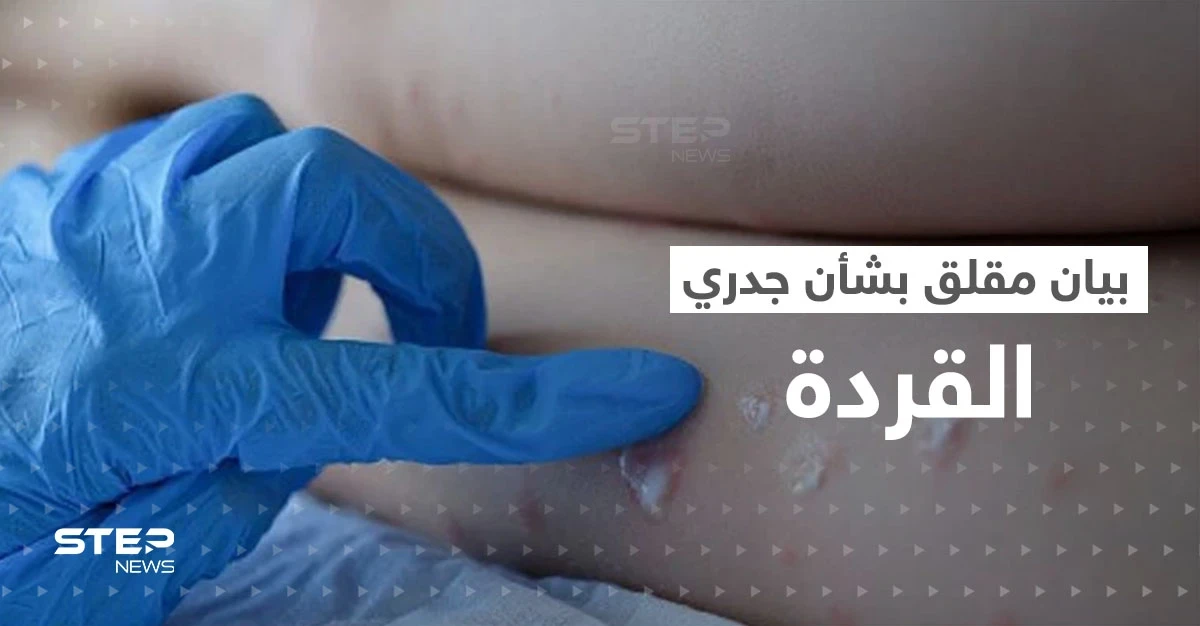 جدري القردة حالة طوارئ دولية.. الصحة العالمية تصدر بياناً "مثيراً للقلق"