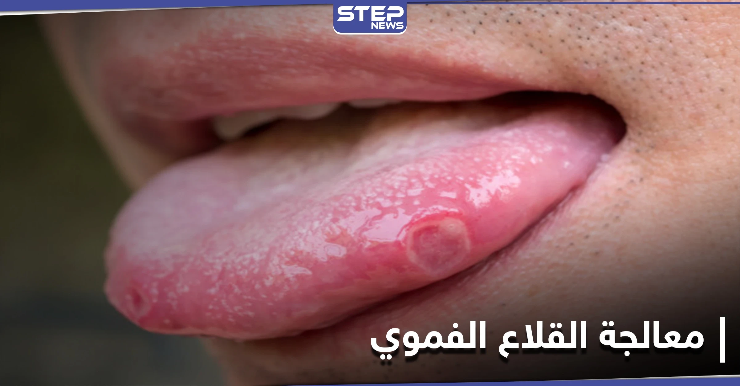 علاجات منزلية مذهلة للتخلص من القلاع الفموي بشكل طبيعي.. إليك 4 طرق