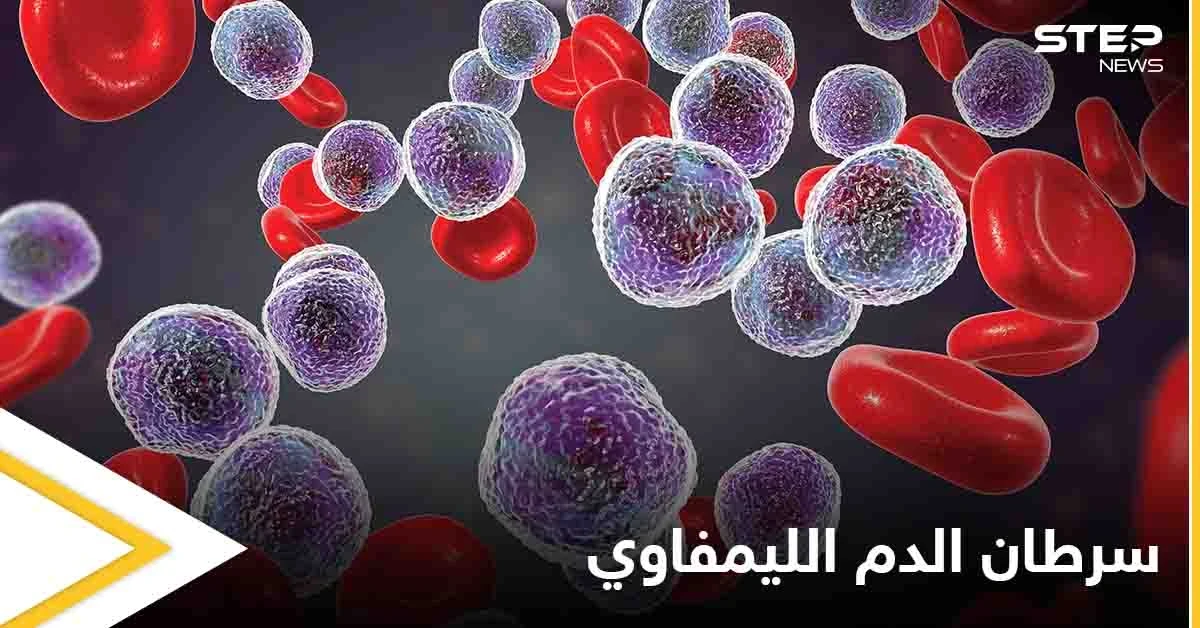 ما هو سرطان الدم الليمفاوي وكيف تظهر أعراضه على المريض إليك أهم المعلومات