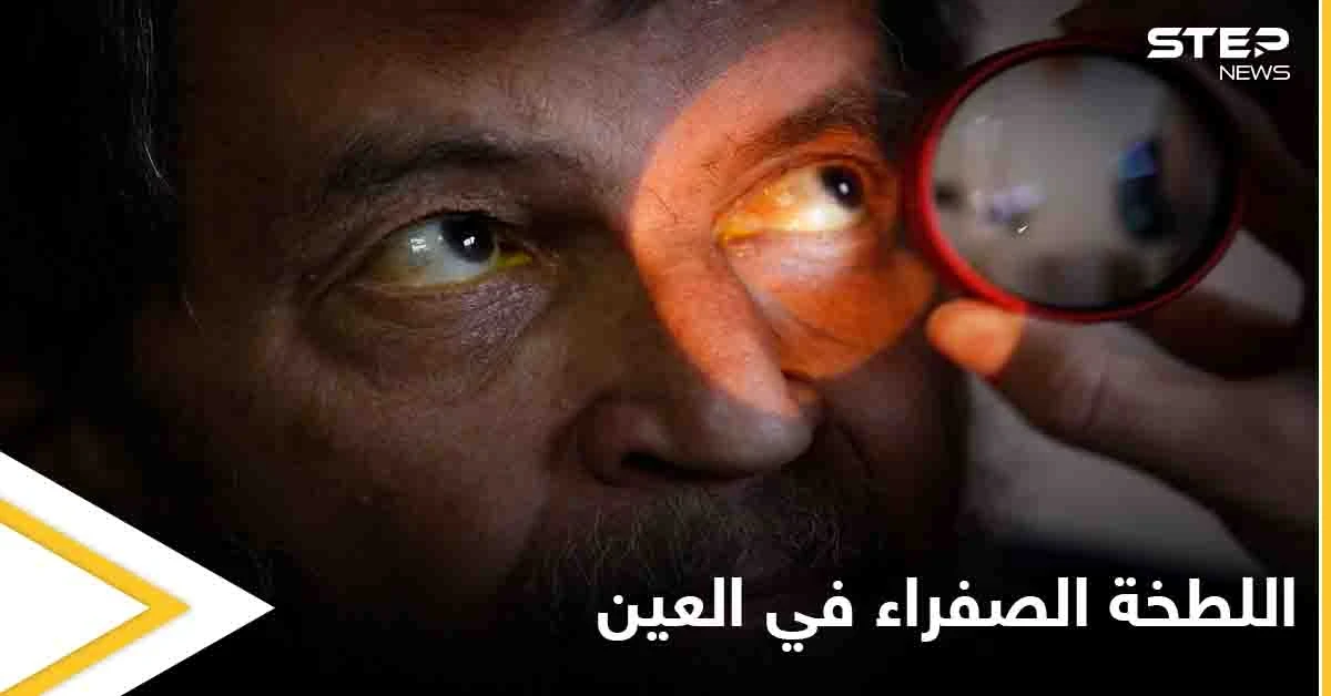 تعرف على أسباب ظهور اللطخة الصفراء في العين وعلاجاتها