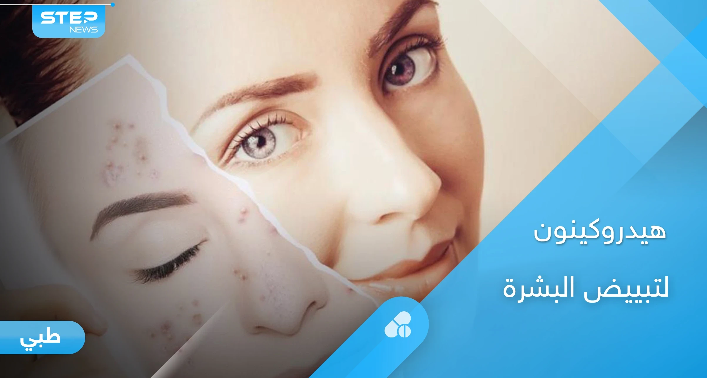 دواء هيدروكينون لتبييض البشرة وإزالة التصبغات.. طرق الاستخدام والآثار الجانبية إليك أهم المعلومات
