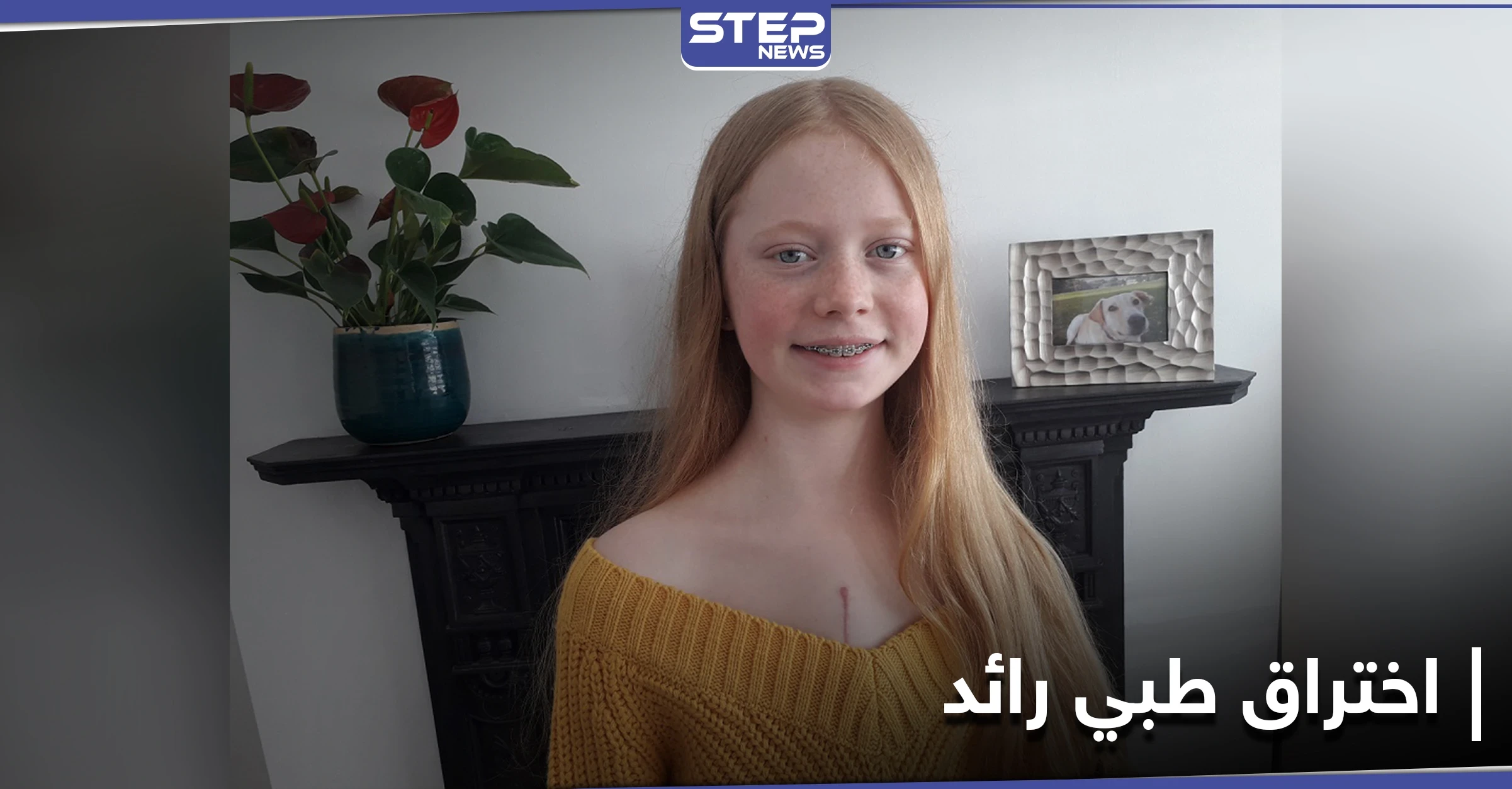 بفضل اختراق طبي كبير في عمليات زراعة القلب.... أُعيدت آنا إلى الحياة من جديد
