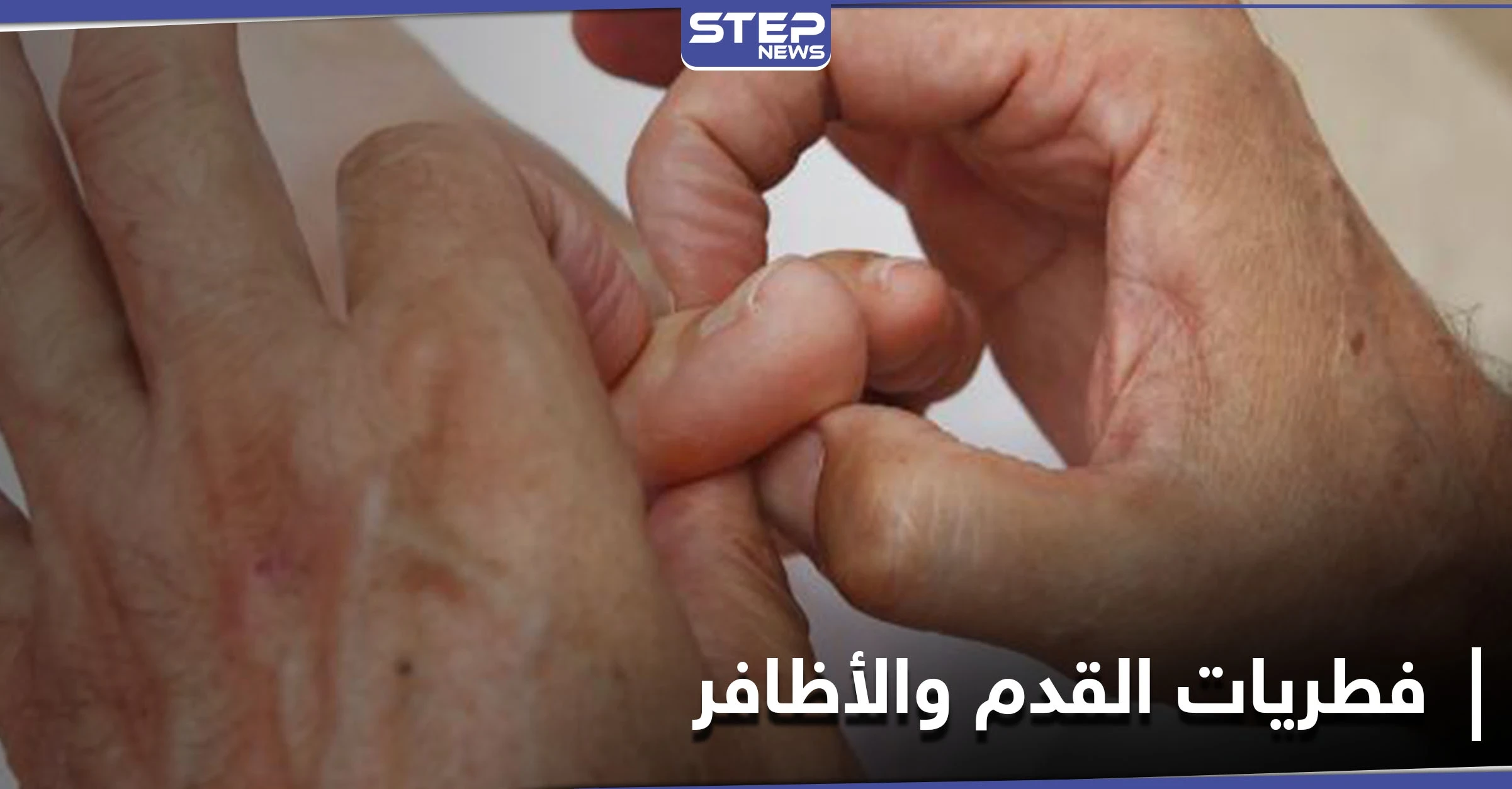 لإيقاف خطر الإصابة بمرض فطريات القدم والأظافر.. إليك 7 نصائح لمكافحته