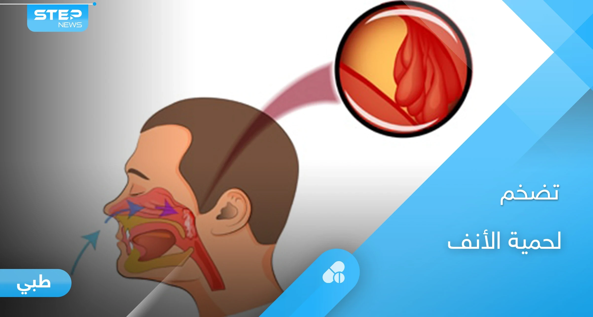 أسباب تضخم لحمية الأنف وطرق اكتشاف اللحمية مبكرًا عند الأطفال