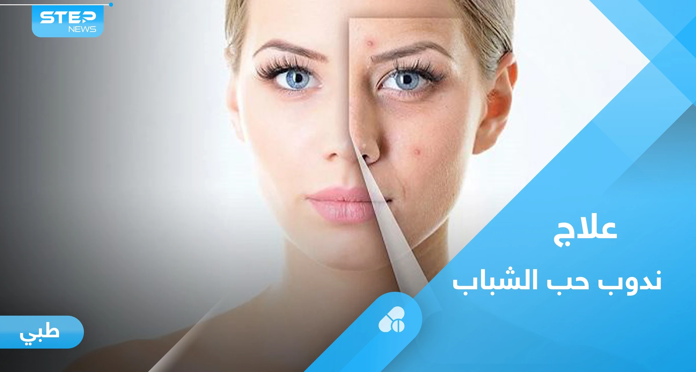 متى يترك حب الشباب ندباً وما الطريقة الأفضل لعلاجه.. إليك رأي الخبراء