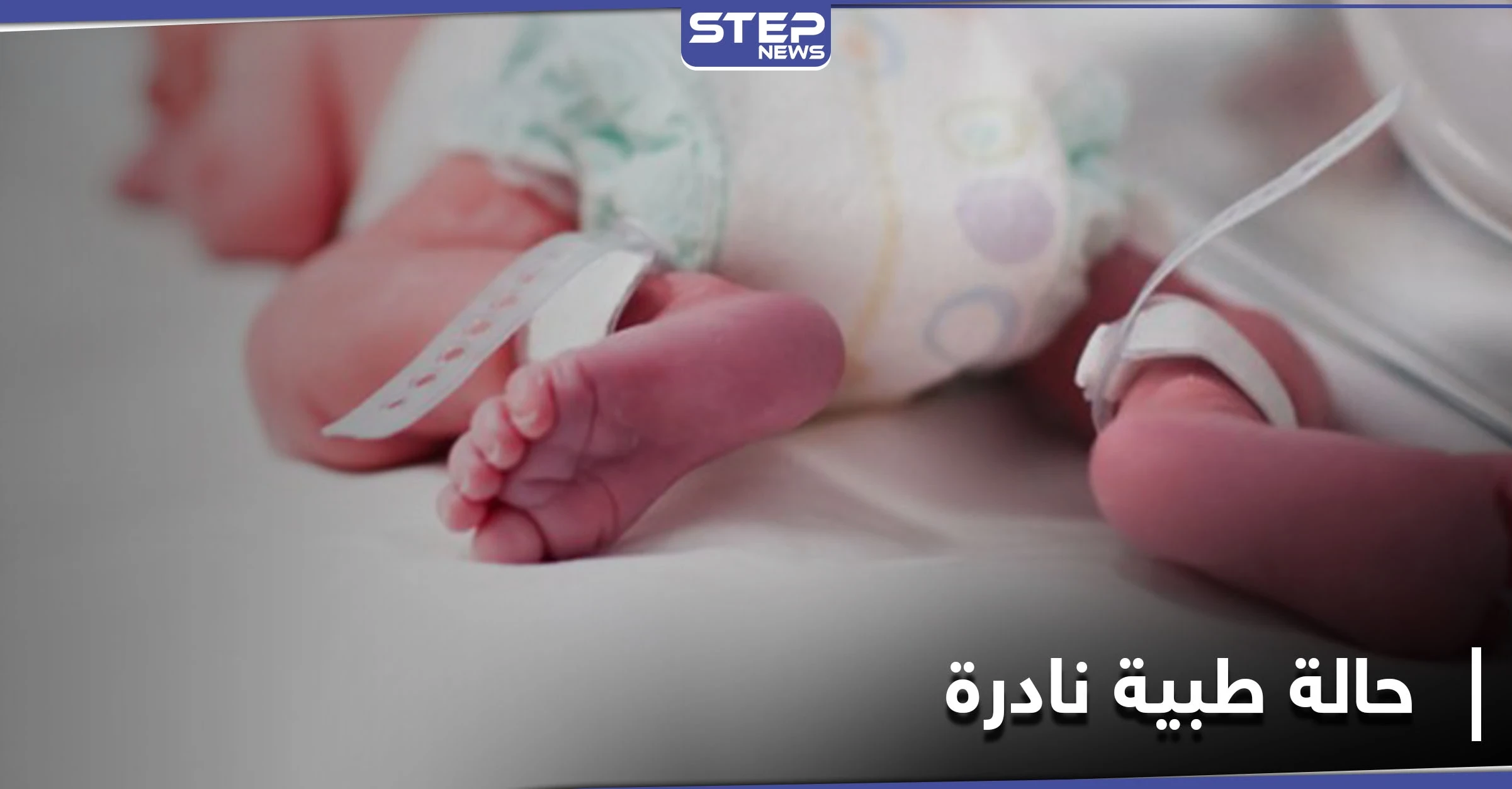 حالة طبية نادرة في بريطانيا.. أم تلد ثلاثة أطفال من رحمين مختلفين في آن واحد