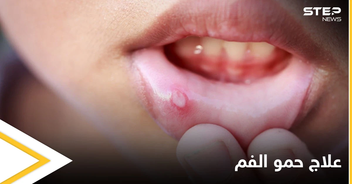 ما هي أسباب ظهور حمو الفم ومتى يكون خطيراً ويحتاج إلى التدخل الطبي إليك أهم المعلومات