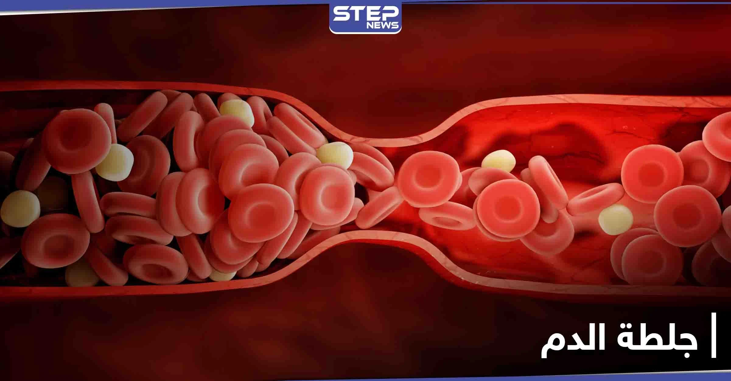 أعراض جلطة الدم وأخطارها وطرق الوقاية منها