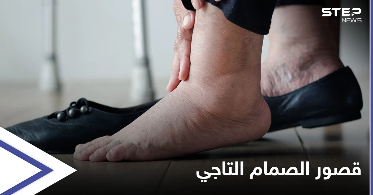 منها تورم القدمين.. تعرف على أعراض قصور الصمام التاجي وأسبابه وطرق العلاج