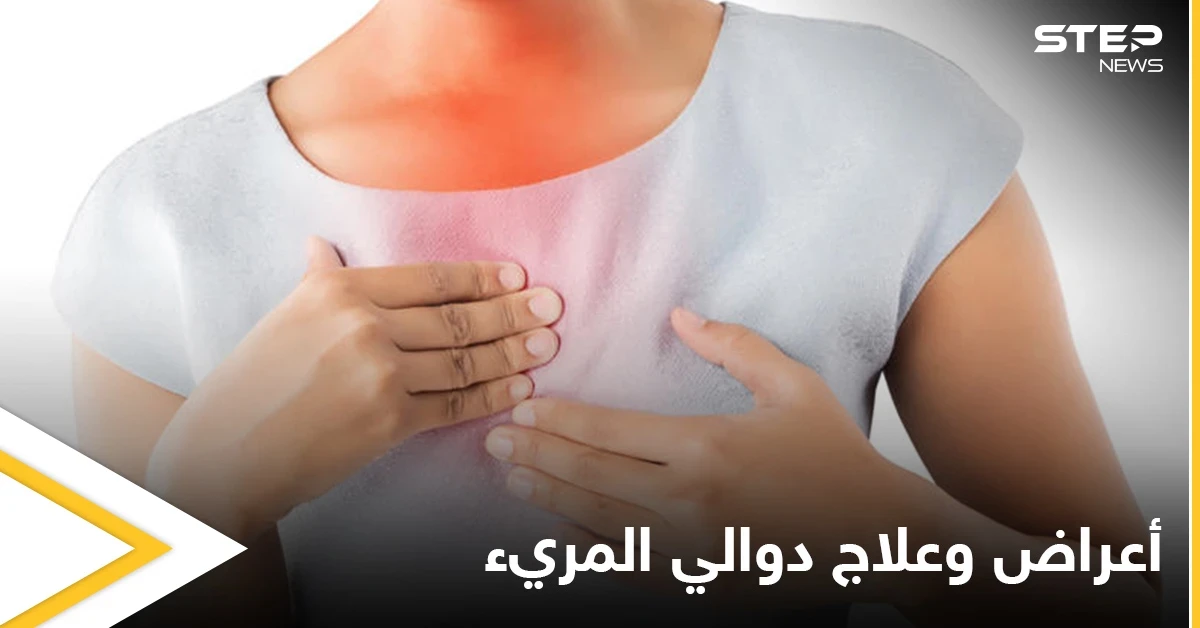 ما هي دوالي المريء وأعراضها وطرق علاجها إليك أهم المعلومات