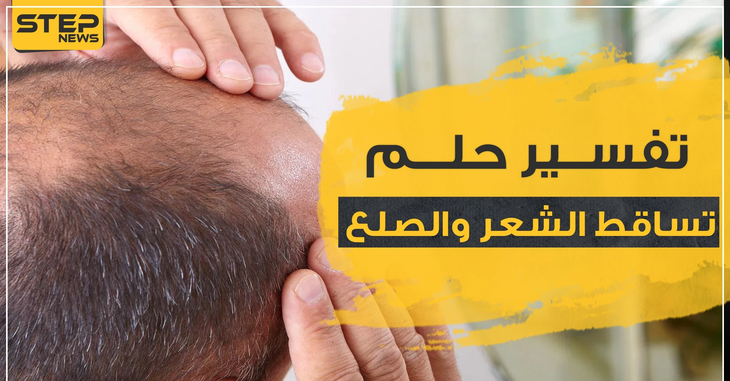 تفسير حلم تساقط الشعر والصلع بحسب ابن سيرين للحامل والمتزوجة والعزباء