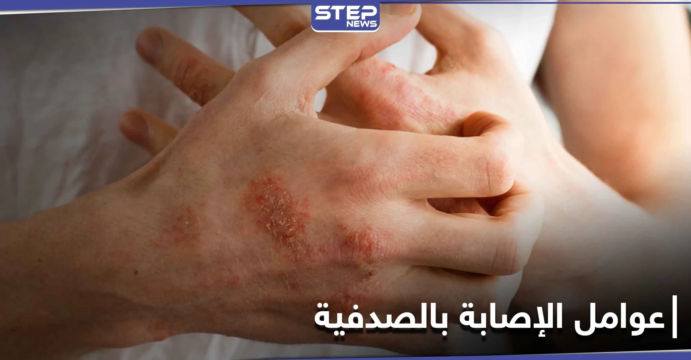 الصدفية تزداد في الفترة الأخيرة.. وهؤلاء الأشخاص هم الأكثر عرضة للإصابة بها