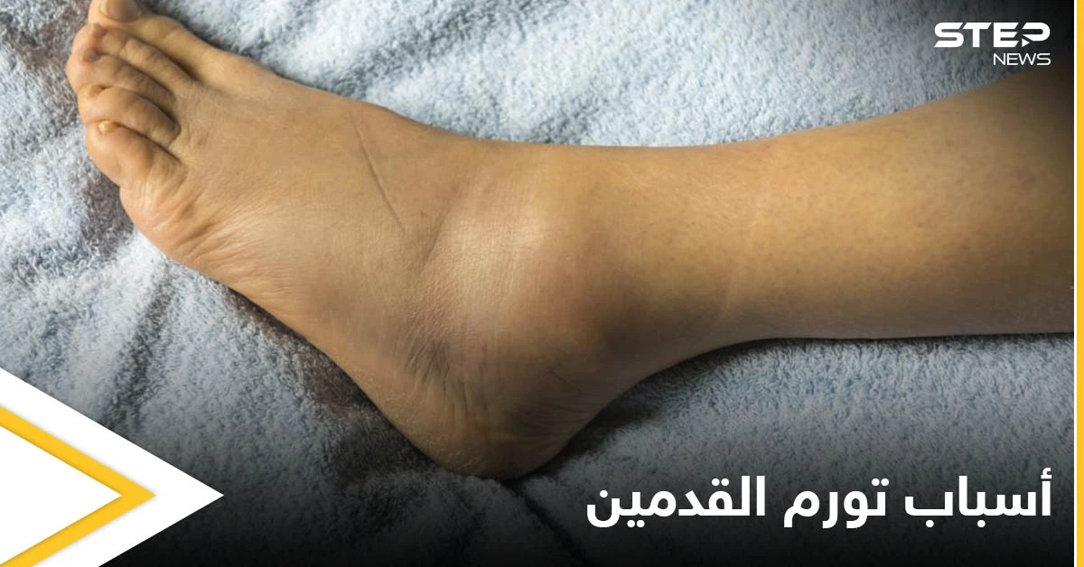 تعرف على أسباب تورم القدمين عند الرجال الأمراض المرتبطة بها