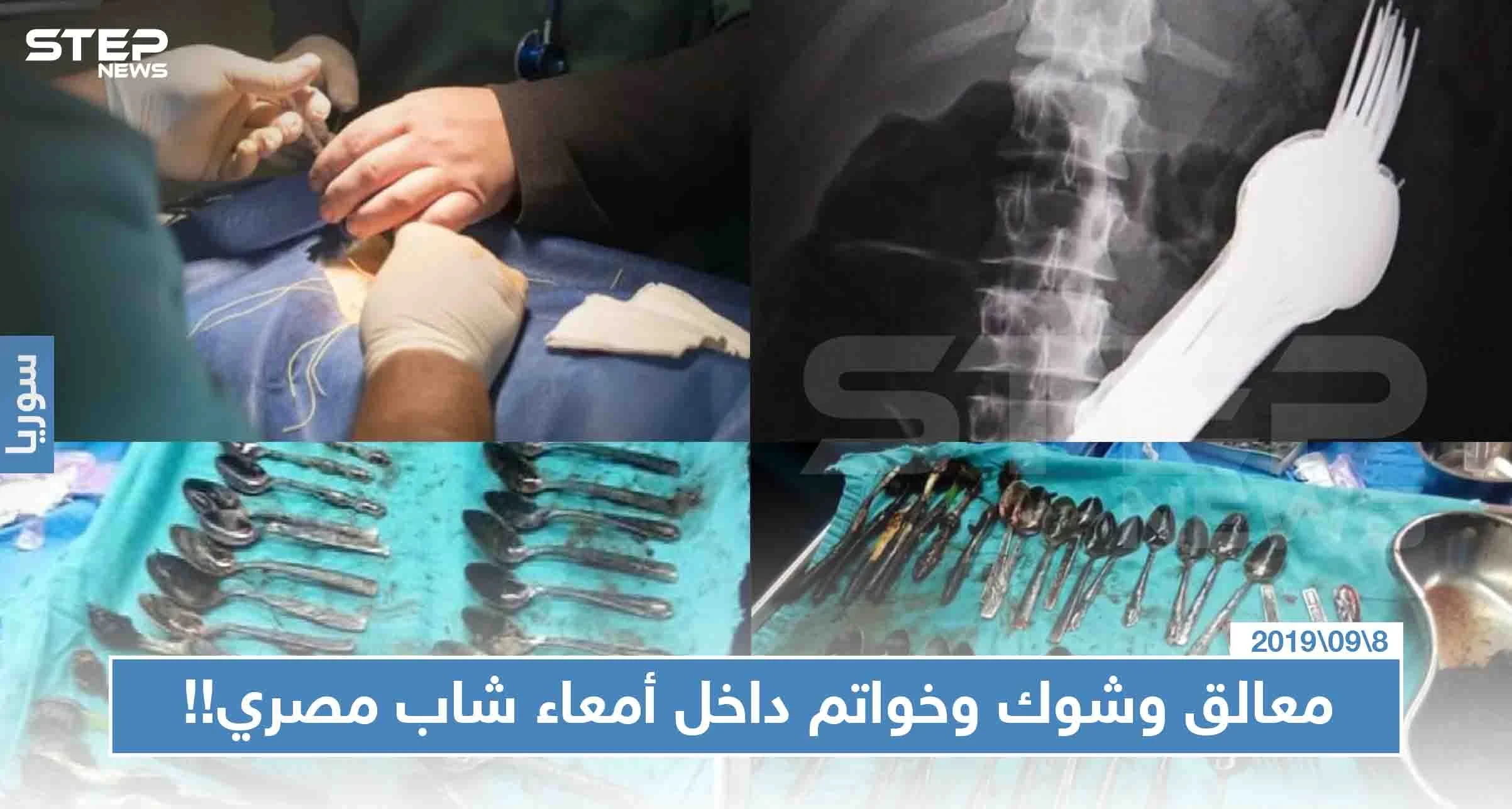 شاب مصري اشتكت والدته من فقدان المعالق والشوك وخاتم ذهبي، فعُثر عليهم داخل معدته!! (صور)
