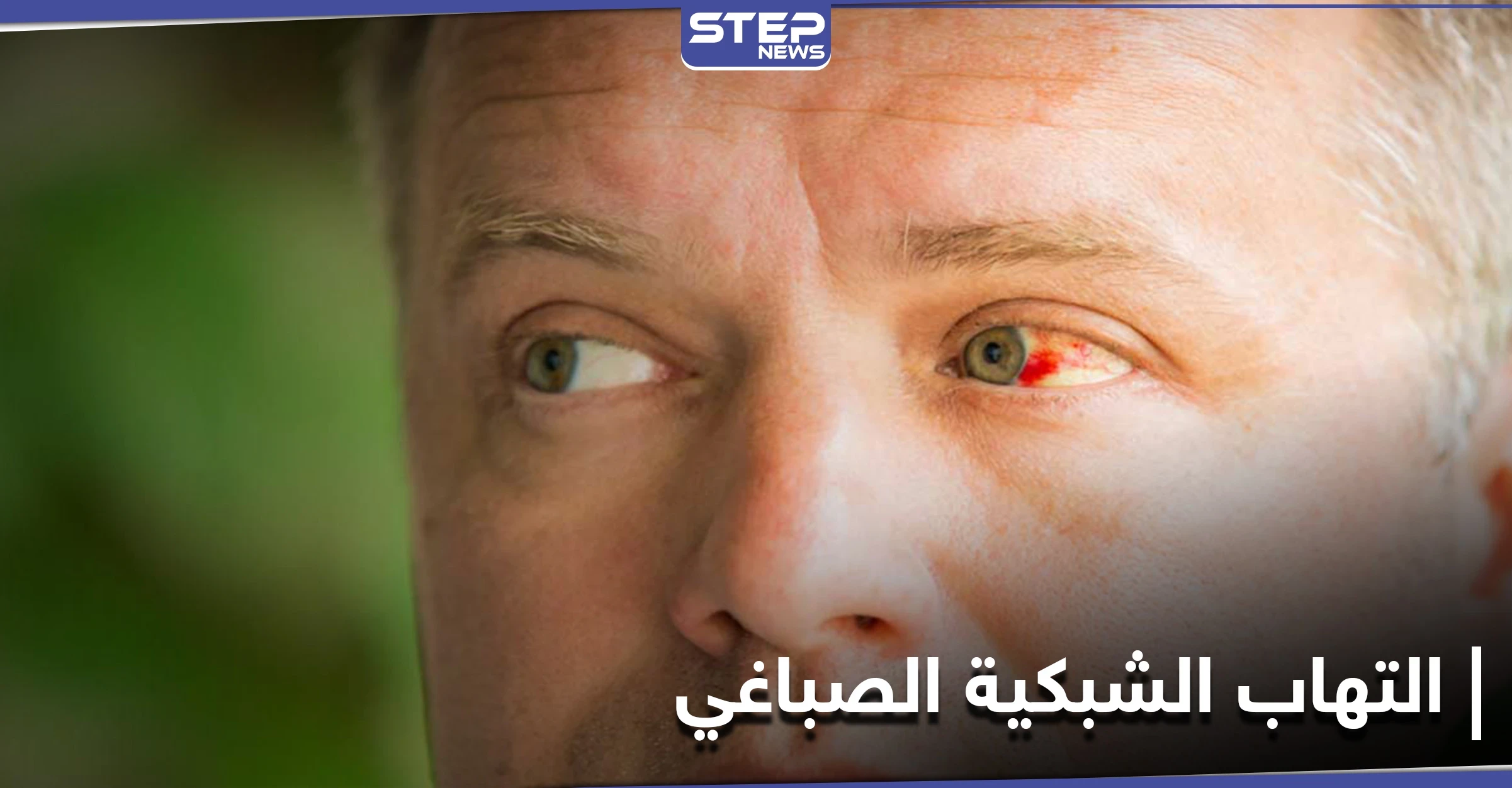أخطر الإصابات العينية.. التهاب الشبكية الصباغي تعرّف إلى أعراضه وعلاجاته