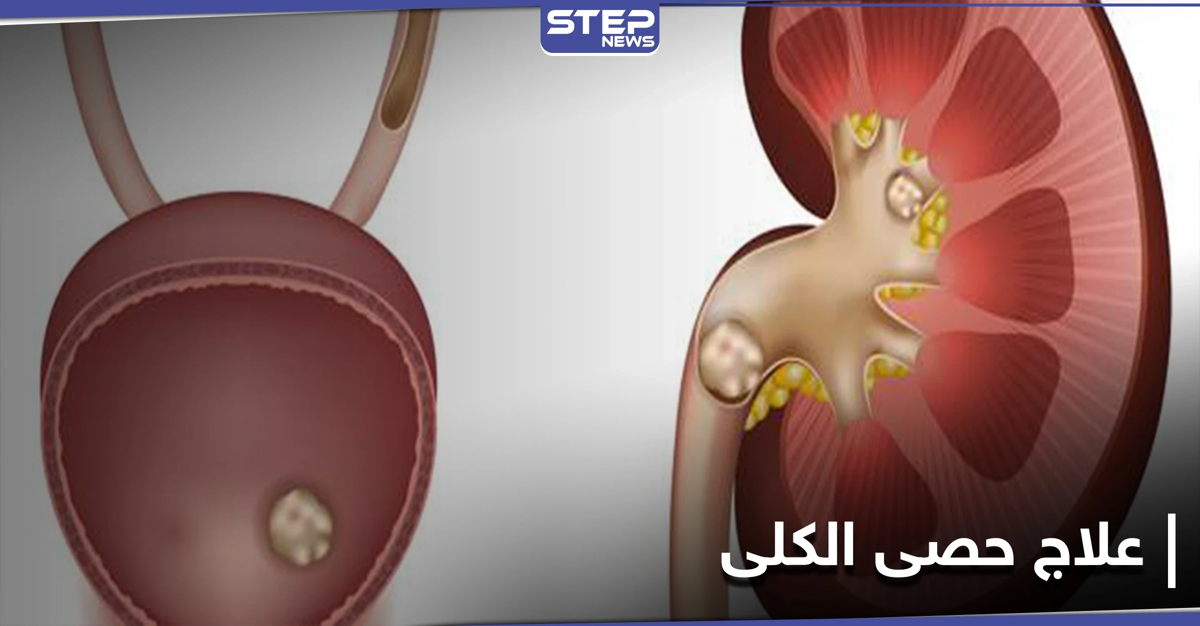 ما لا تعرفه عن حصى الكلى وكيف يمكن معالجتها بالوسائل المنزلية البسيطة