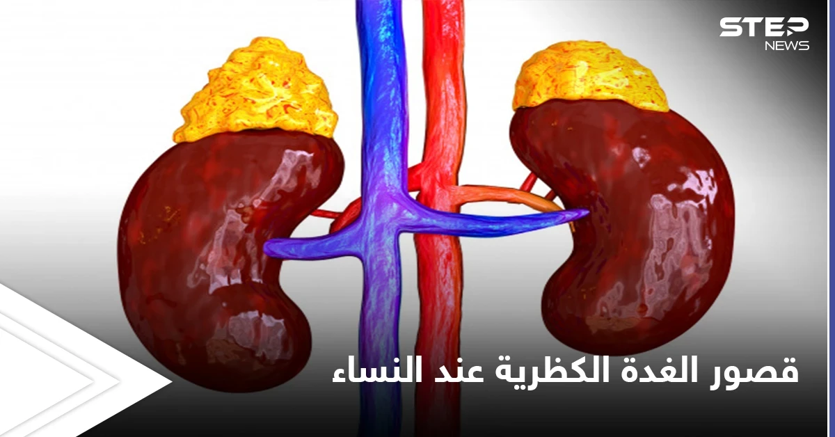 التعايش مع المرض إحدى طرق العلاج.. خطورة قصور الغدة الكظرية عند النساء وأعراضه الشائعة