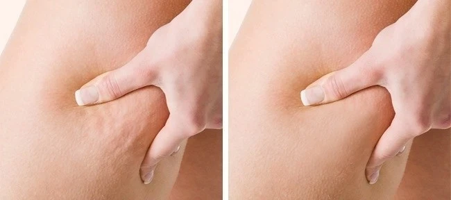 عملية إزالة السيلوليت.. مع تعريفه وطرق إزلته بالليزر بتقنية حديثة