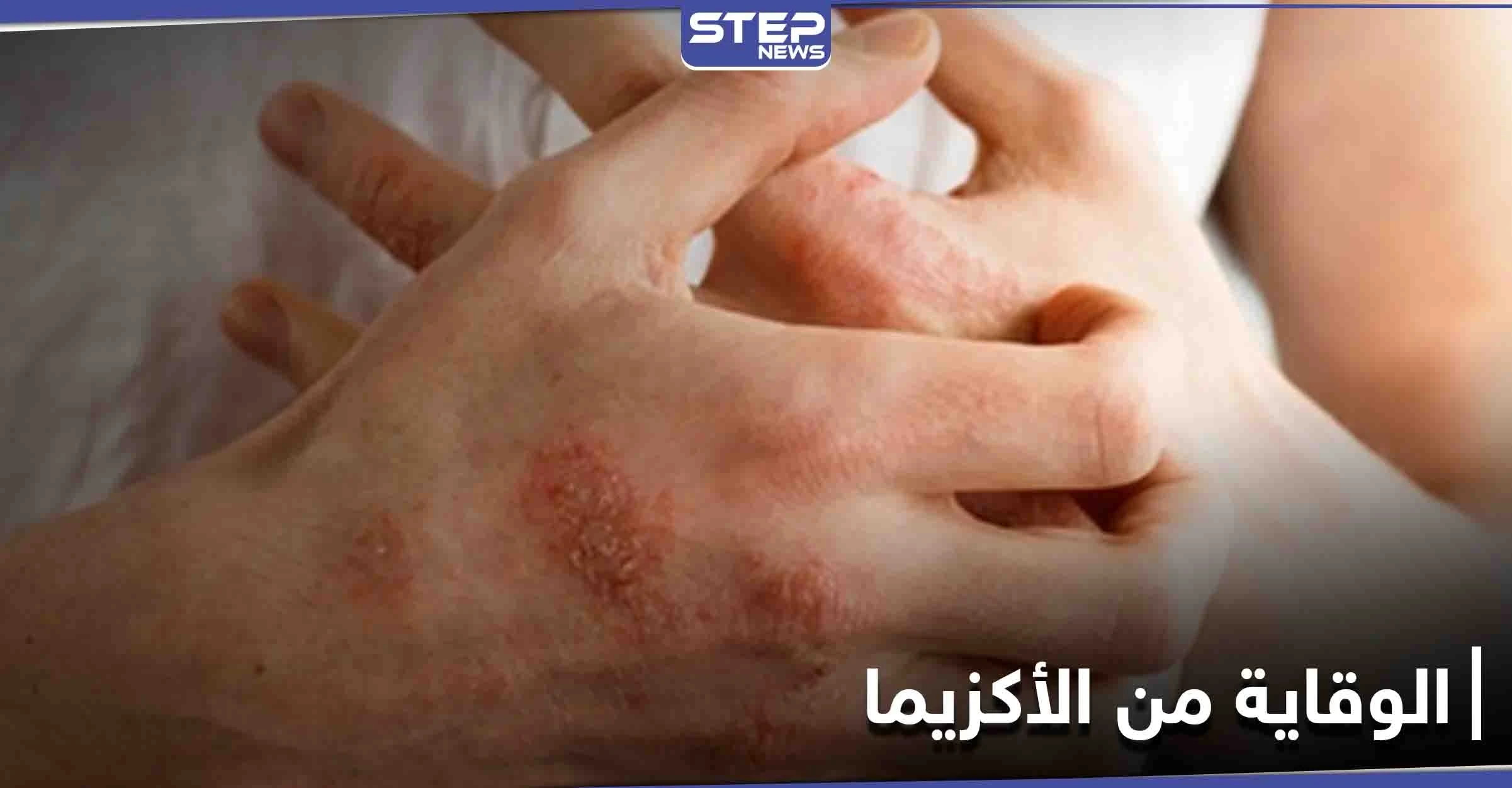 ماهي الأكزيما.. أسباب حدوثها وأهم الطرق للوقاية منها