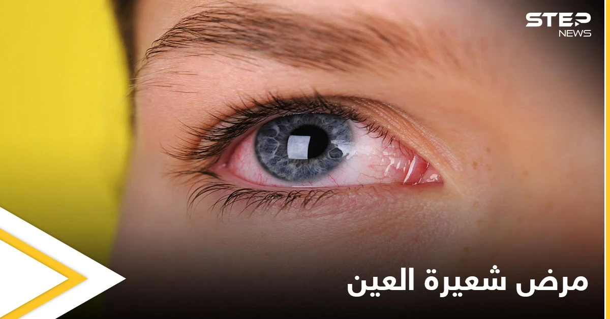 ما هي شعيرة العين وأسباب ظهورها إليك أهم المعلومات