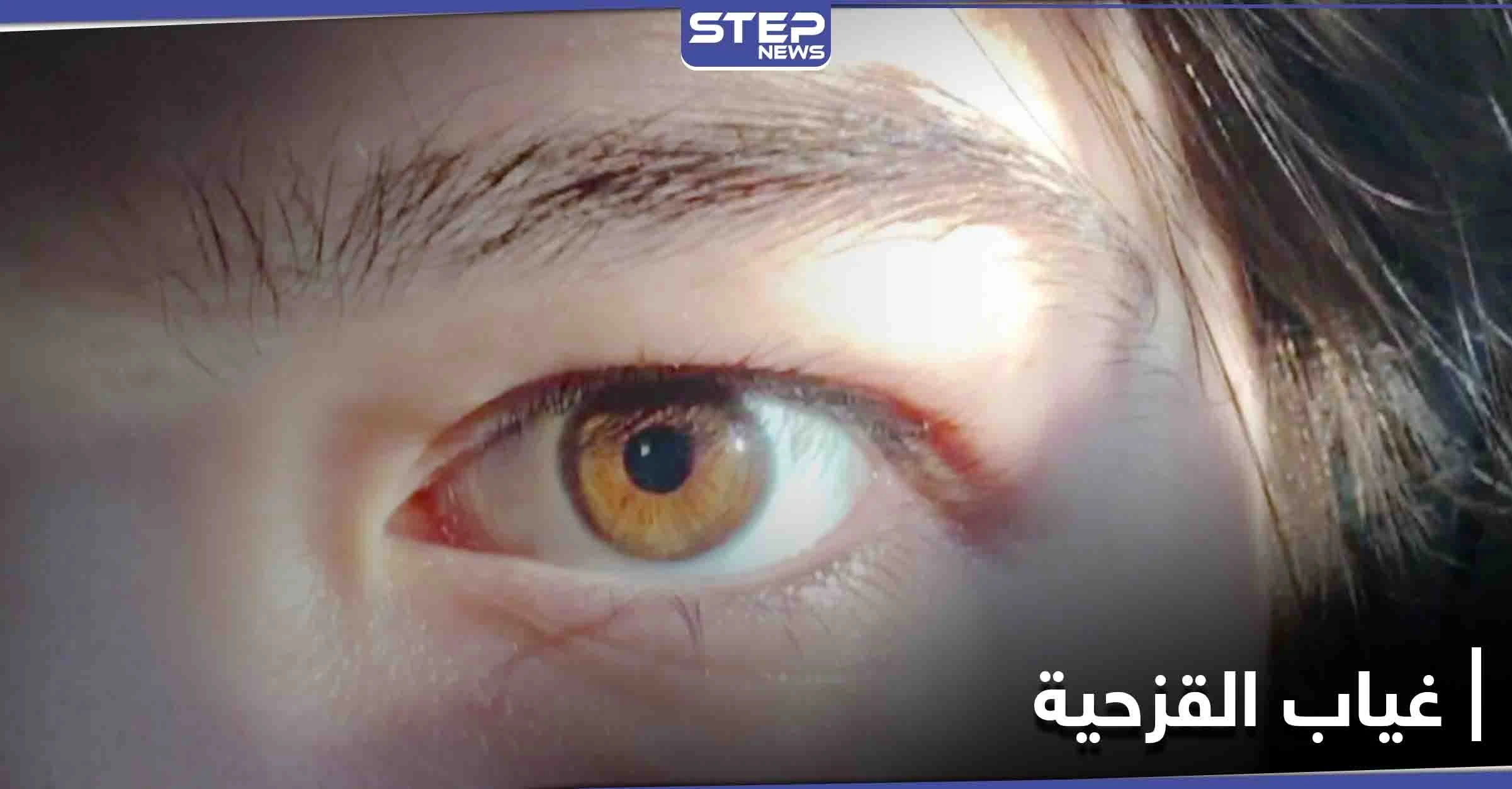 مخاطر مرض غياب القزحية وأسبابه وطرق العلاج