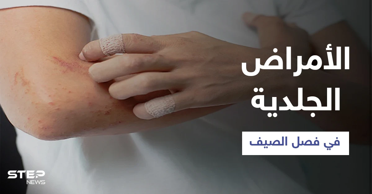 تعرّف على أبرز الأمراض الجلدية الشائعة في فصل الصيف وطرق الوقاية منها