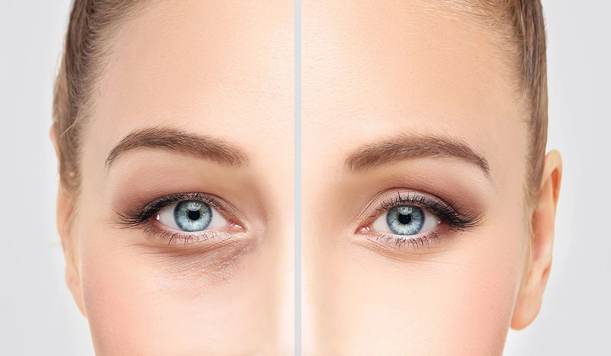 عمليات تجميل العيون .. أنواعها تكلفتها ومخاطرها