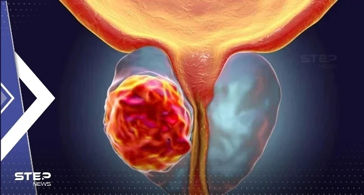 باحثون يكشفون لأوّل مرّة عن إنزيم يمكن استهدافه لقتل سرطان البروستات