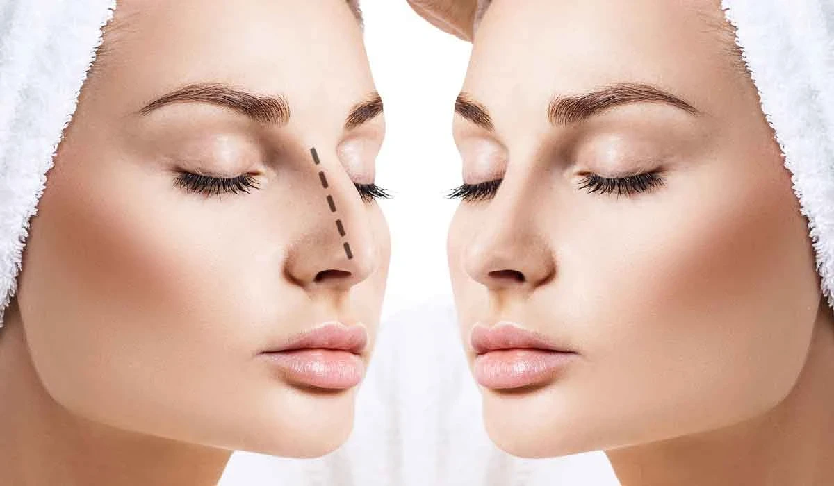 طريقة عملية تجميل الانف وخطوات إجرائها بالتفصيل.. فوائد وأضرار