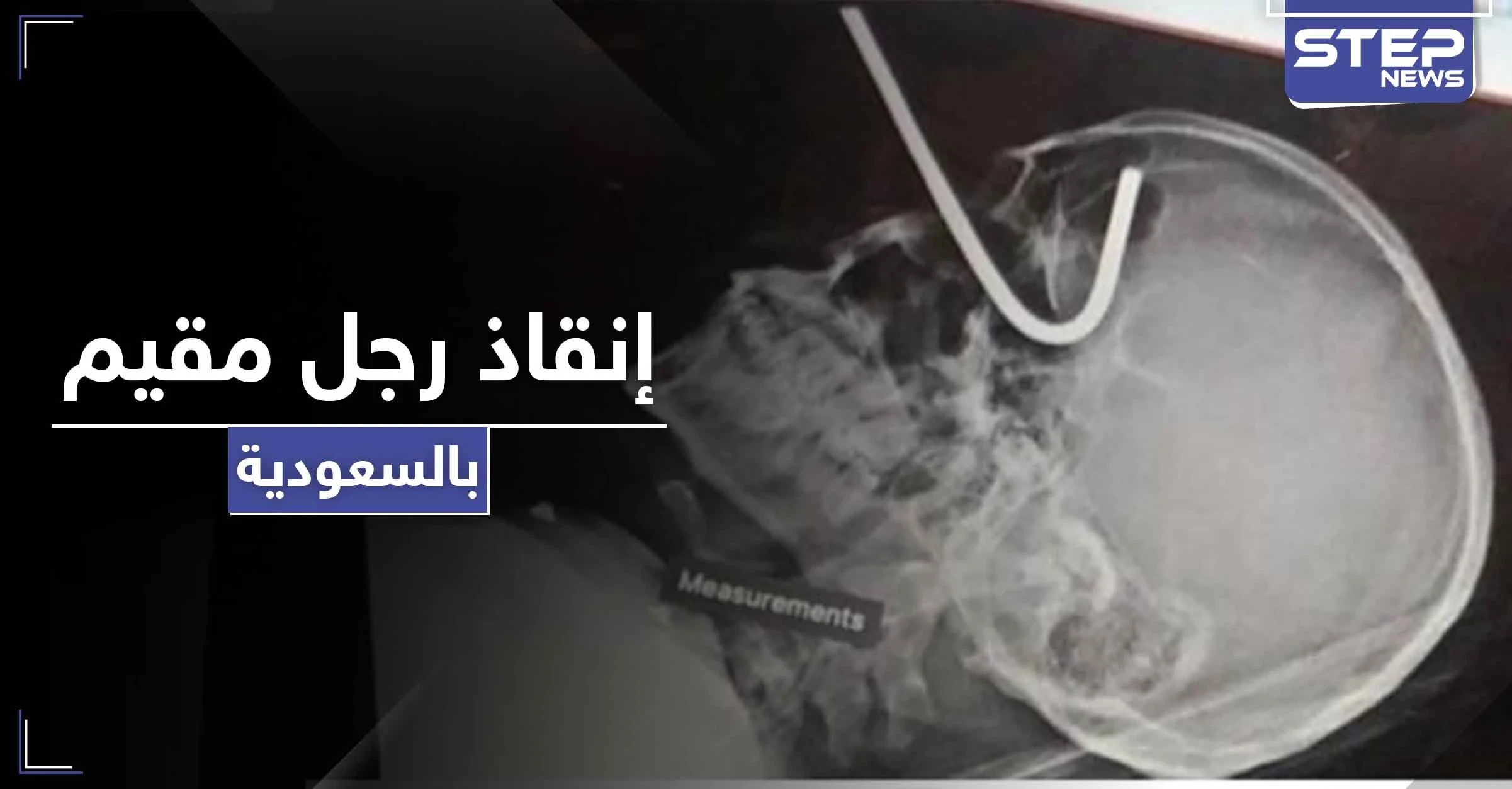 بالصور|| إنقاذ رجل مقيم بالسعودية دخل سيخ تعليق الأضحية بعينه إلى جمجمته