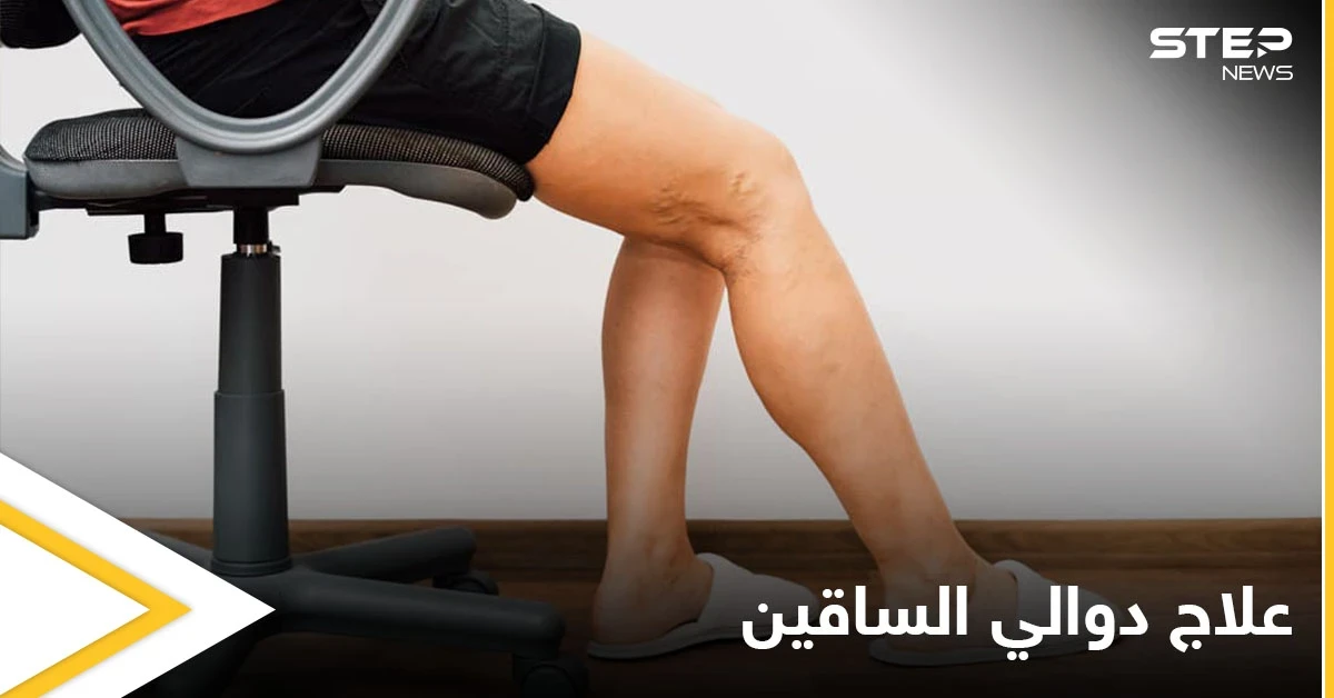 تعرف على أهم الوصفات الطبيعية لعلاج دوالي الساقين