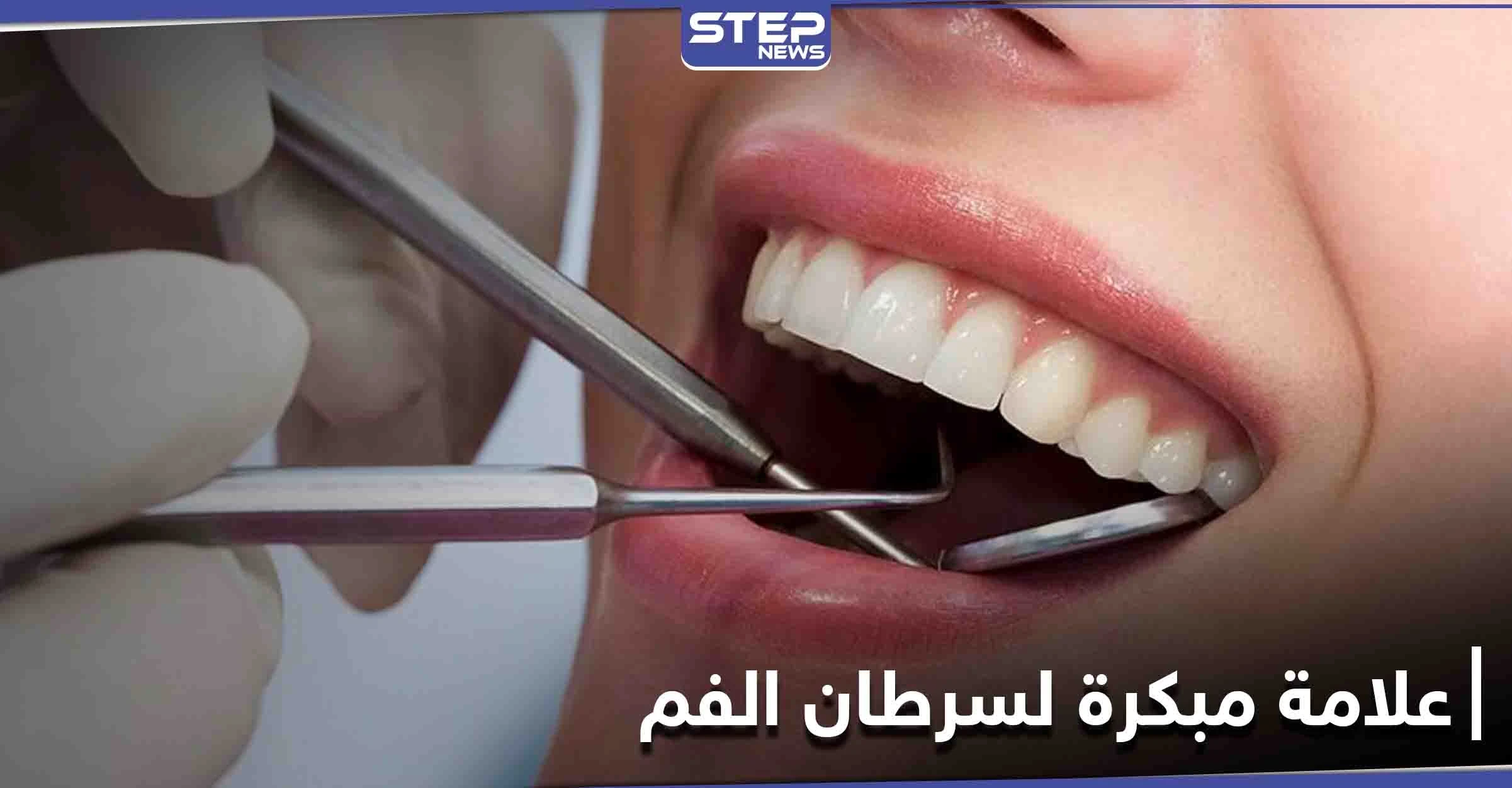 علامة بسيطة على الشفاه غير مبررة قد تكون دليل على الإصابة في سرطان الفم