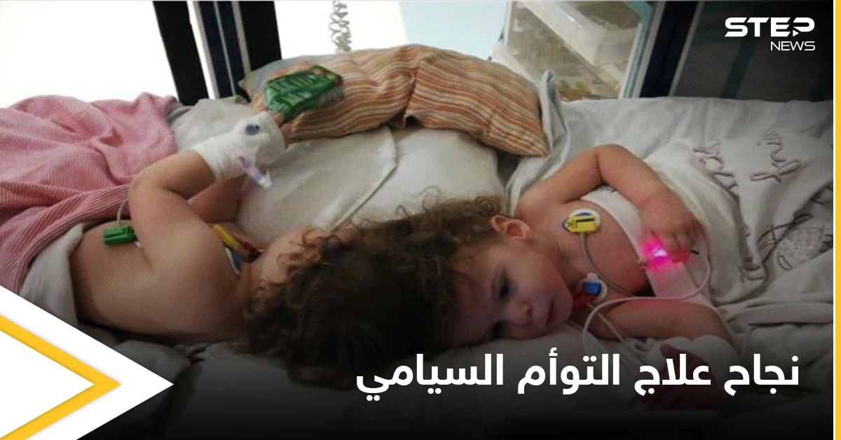 في حالة طبية نادرة.. نجاح علاج التوأم السيامي التركي وقدرتهما على المشي ومصادر تكشف التفاصيل