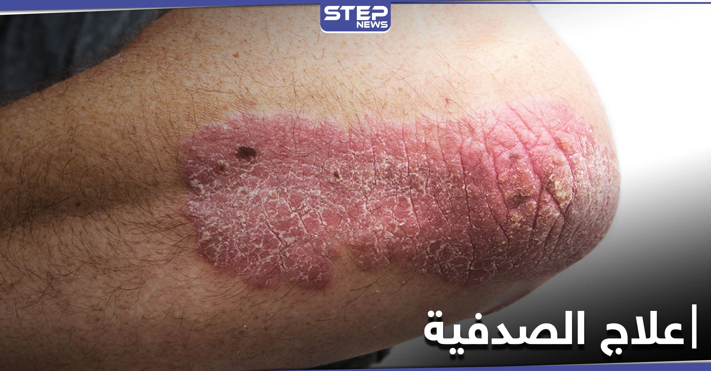 أثر النظام الغذائي على علاج الصدفية.. أنواعها وطرق الوقاية منها