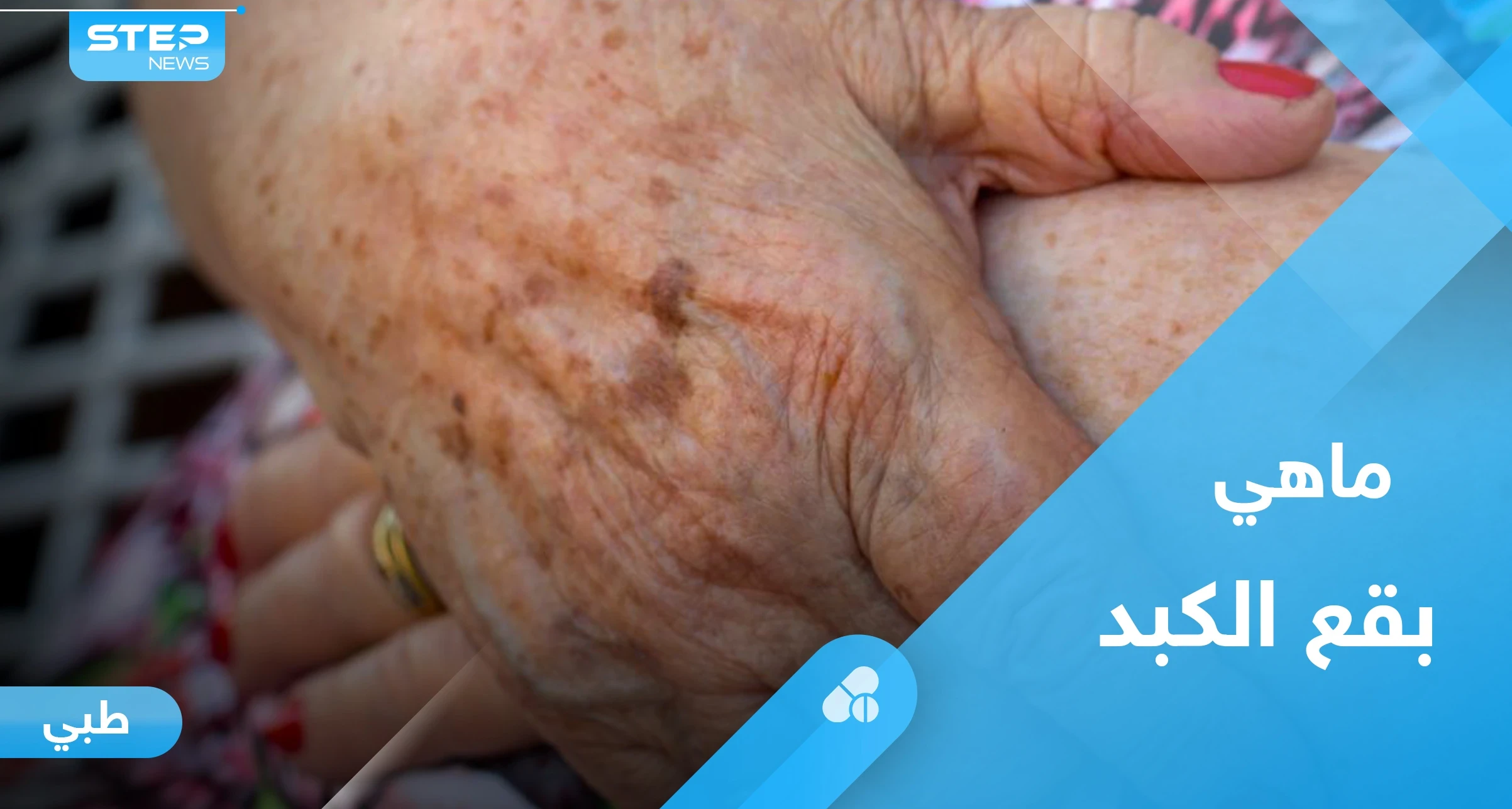 بقع الكبد.. ما هي ومتى تستدعي القلق