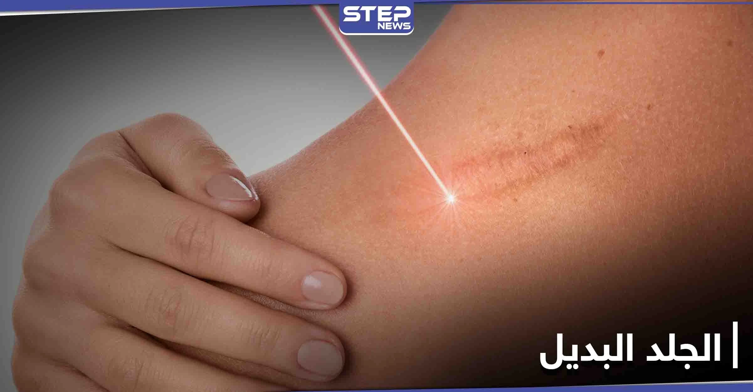 مسدس طبي.. اختراق يولد جلداً بديلاً ويغطي الحروق