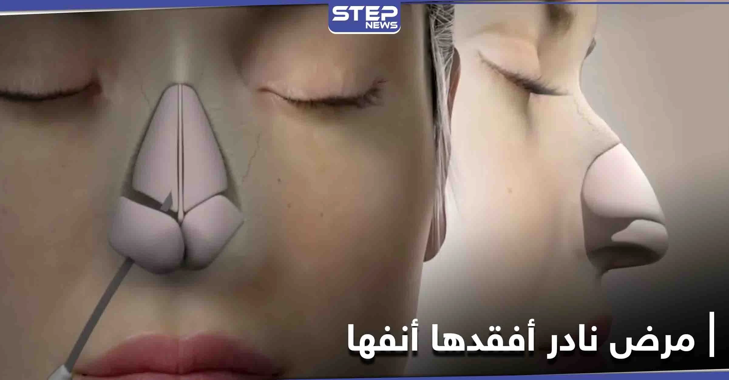 مرض نادر أصابها فأصبحت بلا أنف والأطباء يكشفون الأعضاء المعرضة لهذا التلف