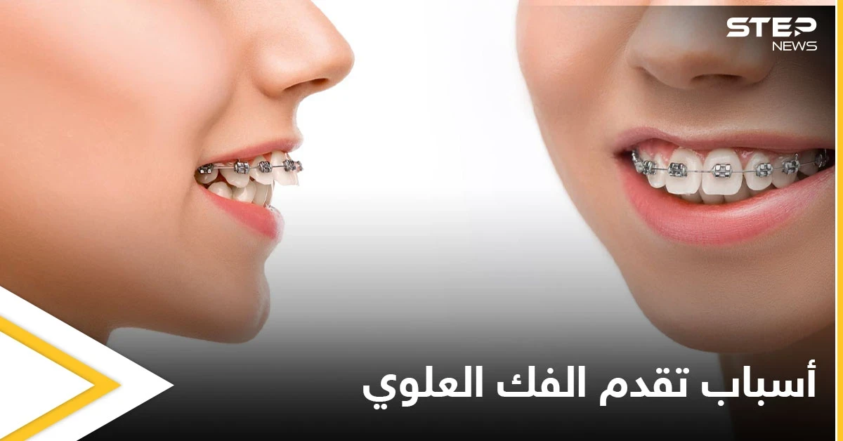 هل هي الوراثة.. الكشف عن أسباب تقدم الفك العلوي وأعراضه وطرق العلاج