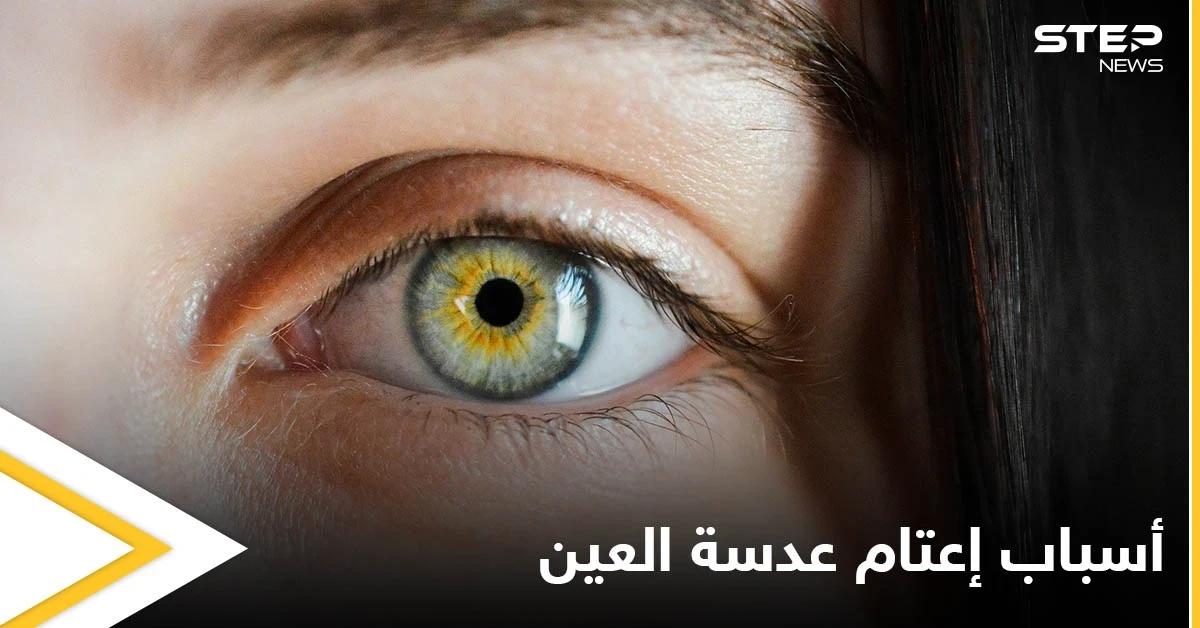 التدخين أحد أسبابه.. إعتام عدسة العين وخطورته وأبرز المسببات لحدوثه إليك اهم المعلومات