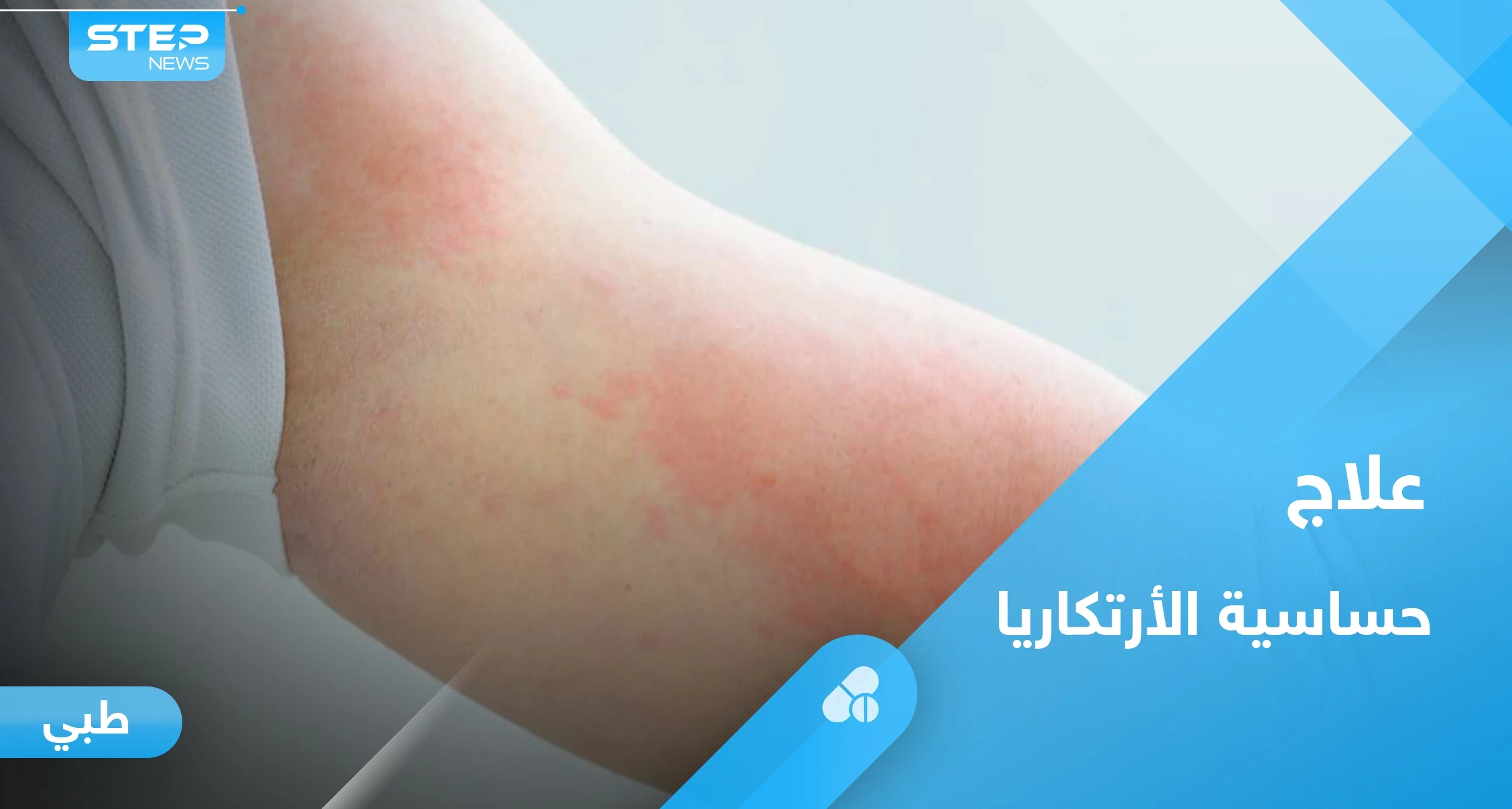 ما هي حساسية الأرتكاريا.. تعرف على أسبابها وأبرز طرق العلاج