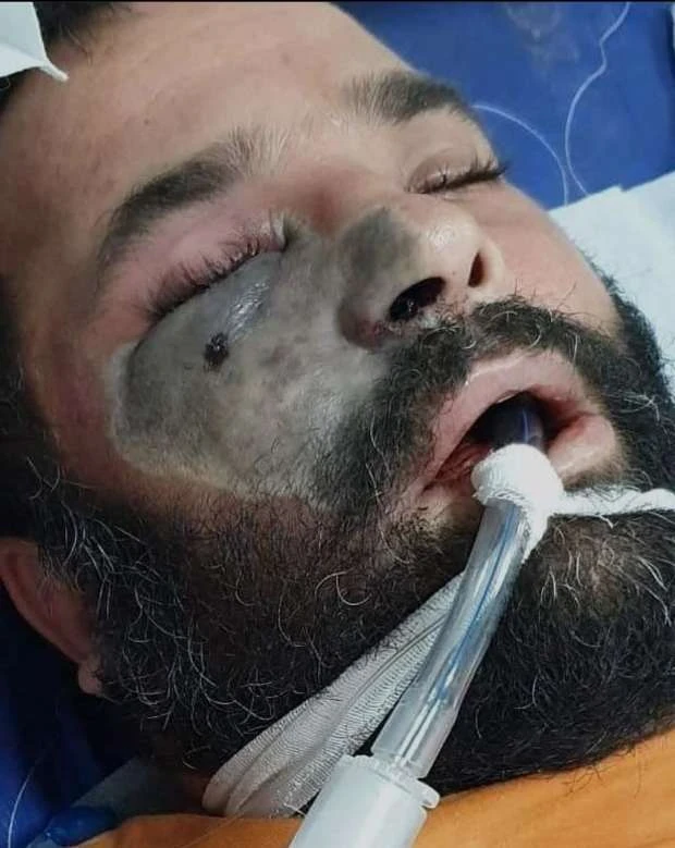 مصر تصدر بياناً بشأن تطورات الإصابة بـ الفطر الأسود.. ورئيس لجنة الصحة يناشد المواطنين