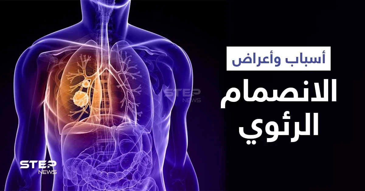 ماهو الانصمام الرئوي ومضاعفاته الخطيرة وعلاقته بالجلطة إليك أهم المعلومات