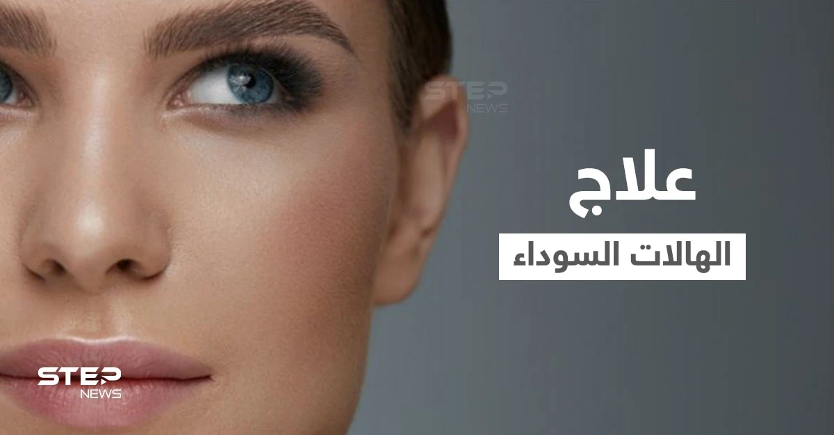 علاج الهالات السوداء "ازرقاق تحت العين" في المنزل وبطرق طبية إليك أهم المعلومات